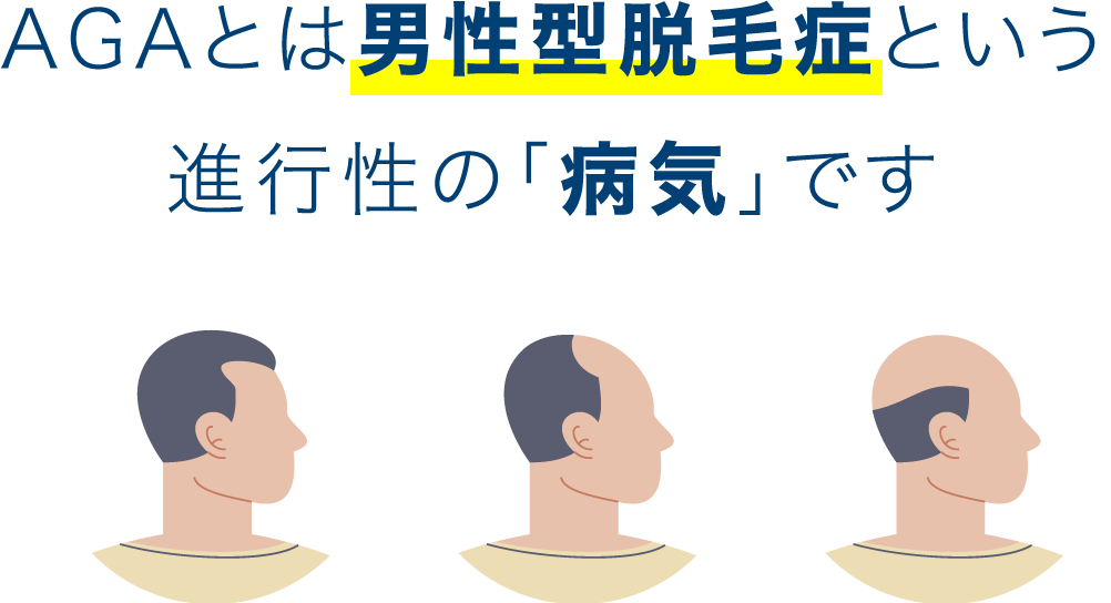 AGAとは男性型脱毛症という進行性の「病気」です